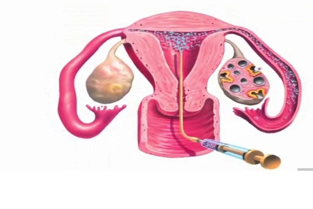 IUI process and treatment